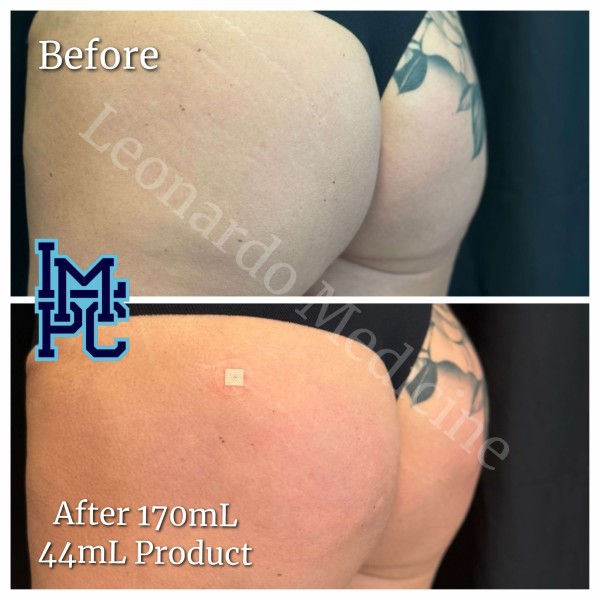 Butt Lift treatment 23