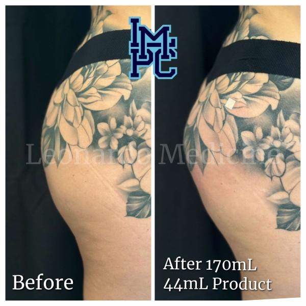Butt Lift treatment 25