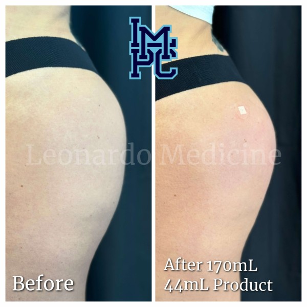 Butt Lift treatment 26