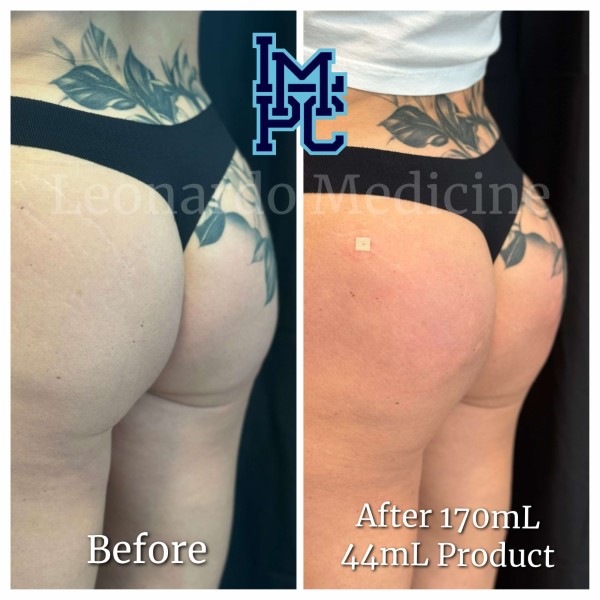 Butt Lift treatment 27