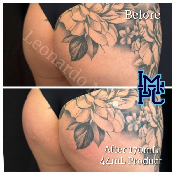Butt Lift treatment 28