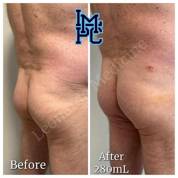 Butt Lift treatment 3