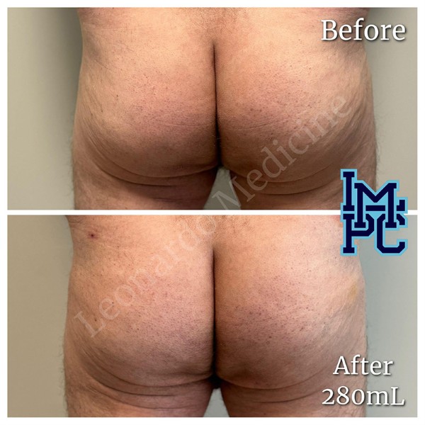 Butt Lift treatment 4