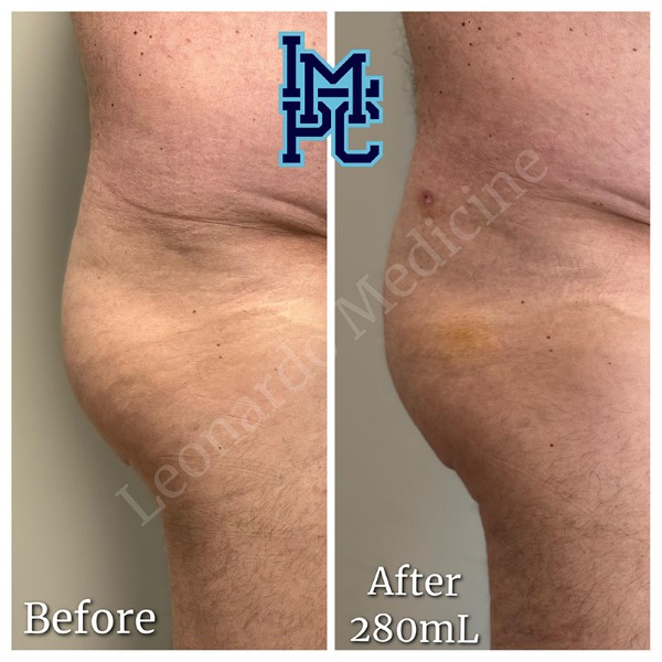 Butt Lift treatment 5