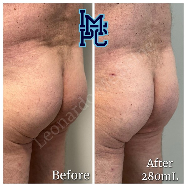 Butt Lift treatment 6
