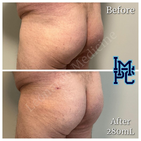 Butt Lift treatment 7