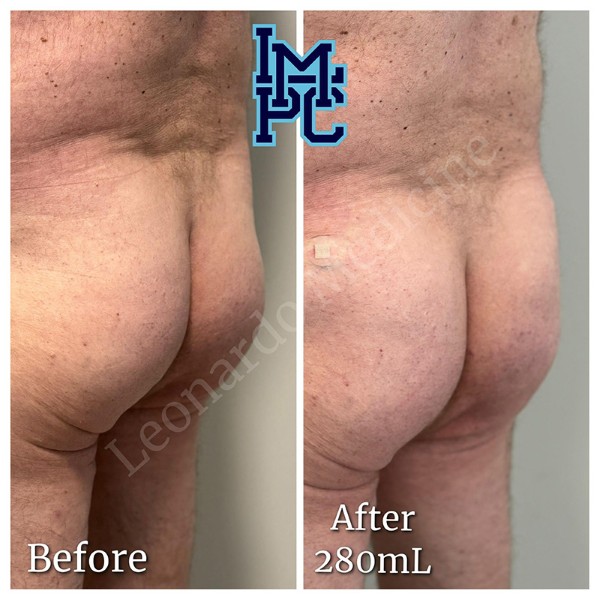 Butt Lift treatment 8