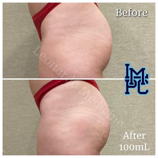 Butt Lift treatment 9