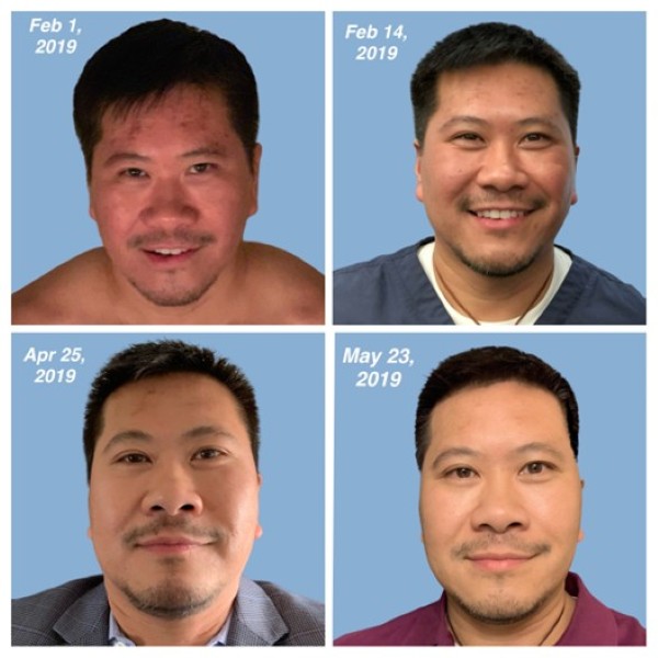 Acne Treatment Using CO2 Lift® PRO Treatment