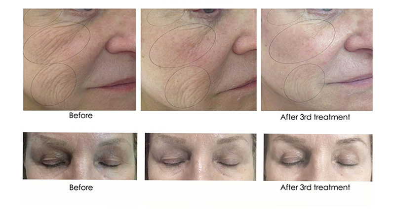 Skin Plumping & Rejuvenation Using CO2 Lift® PRO Treatment