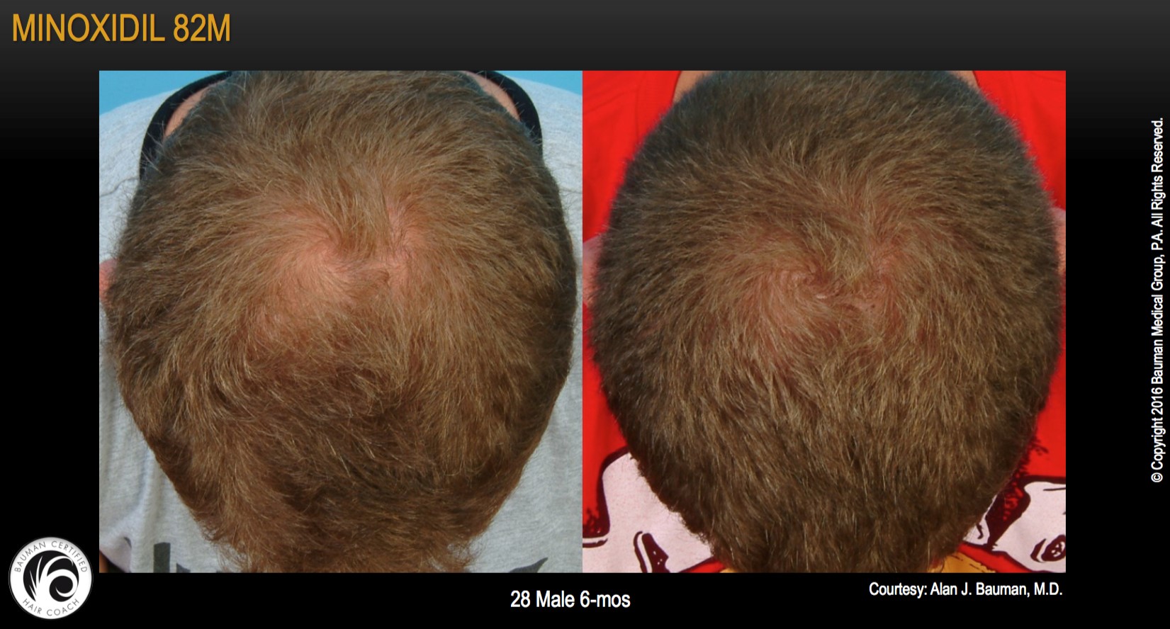 Minoxidil 82M before and after