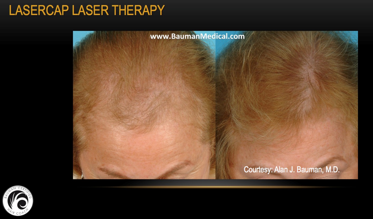 Lasercap Therapy Before and After