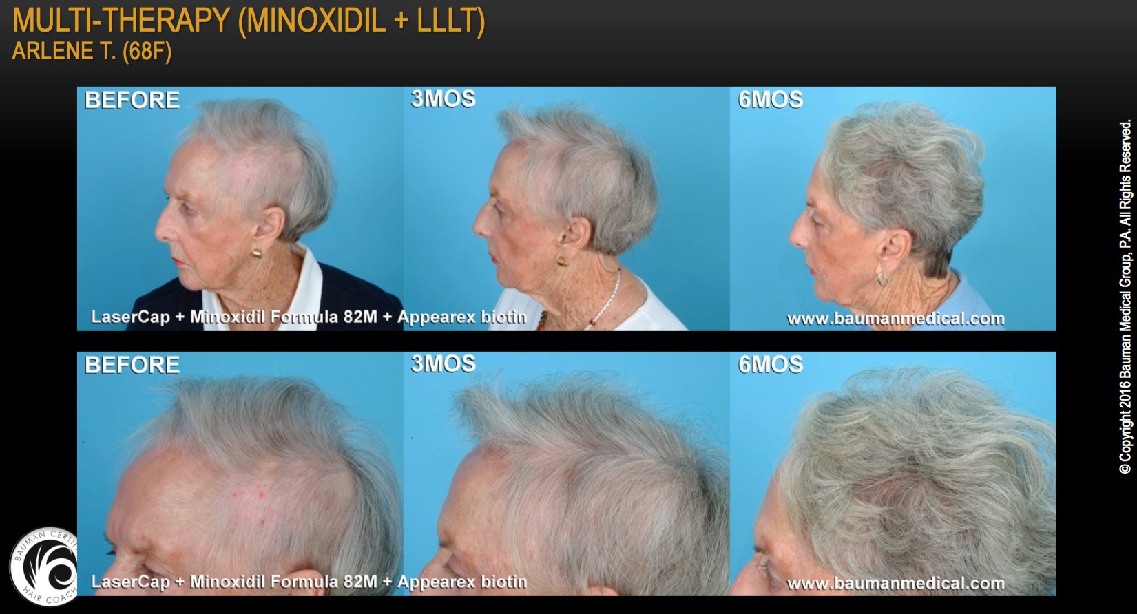 Multi-Therapy (Minoxidil + LLLT)