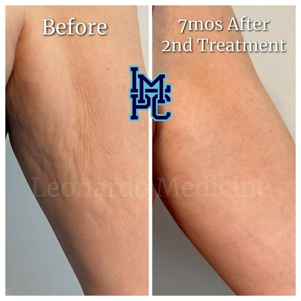 Dilute Radiesse treatment 1