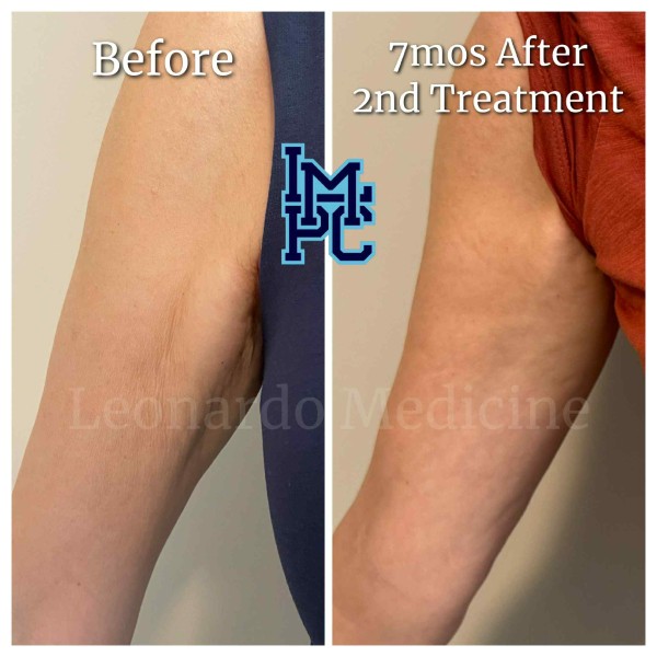 Dilute Radiesse treatment 10