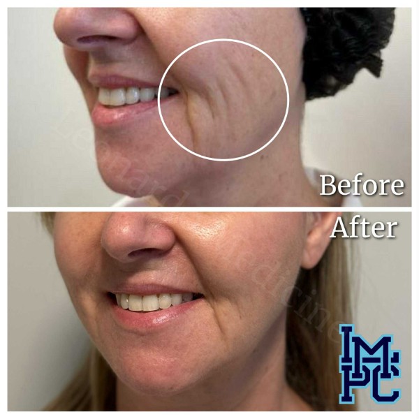 Dilute Radiesse treatment 11