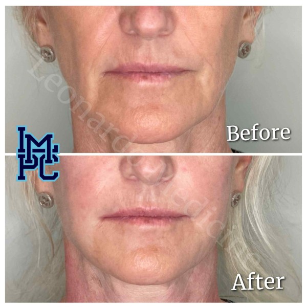 Dilute Radiesse treatment 12