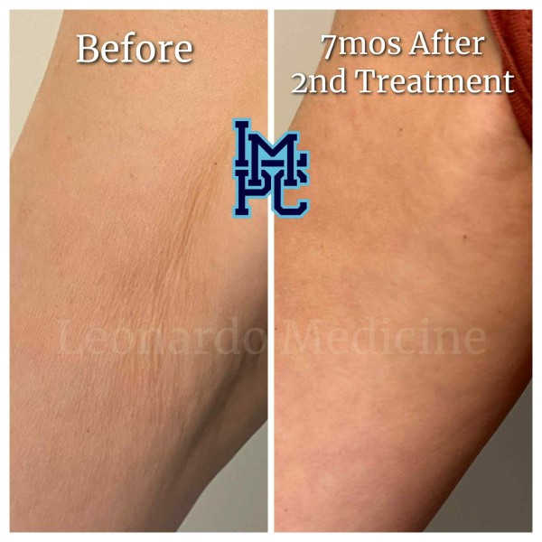 Dilute Radiesse treatment 13