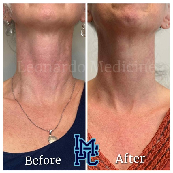Dilute Radiesse treatment 14