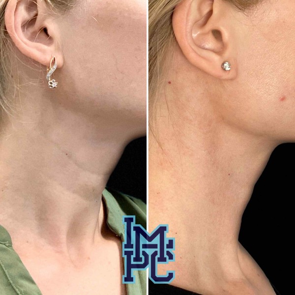 Dilute Radiesse treatment 16