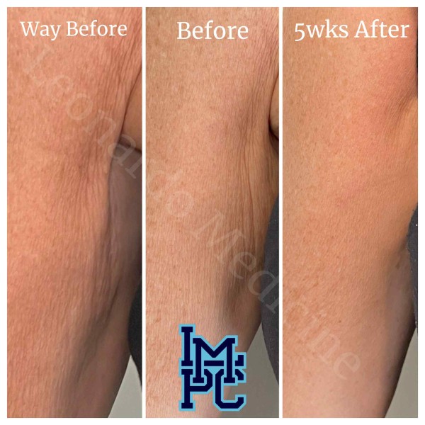 Dilute Radiesse treatment 17