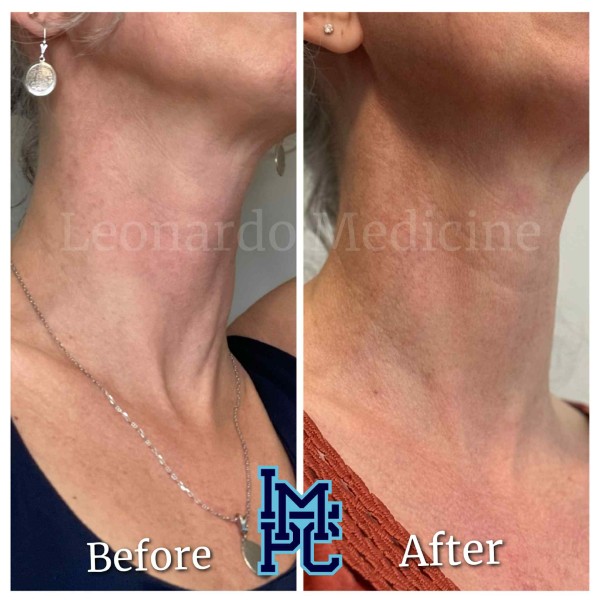 Dilute Radiesse treatment 18