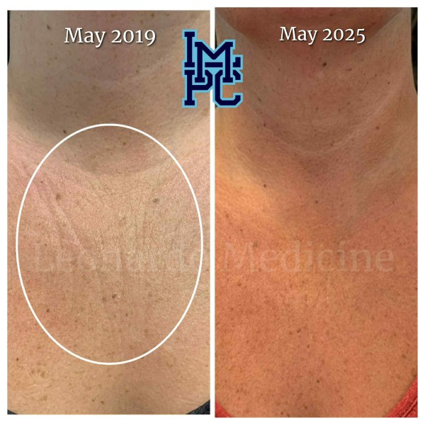 Dilute Radiesse treatment 19