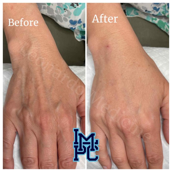 Dilute Radiesse treatment 2