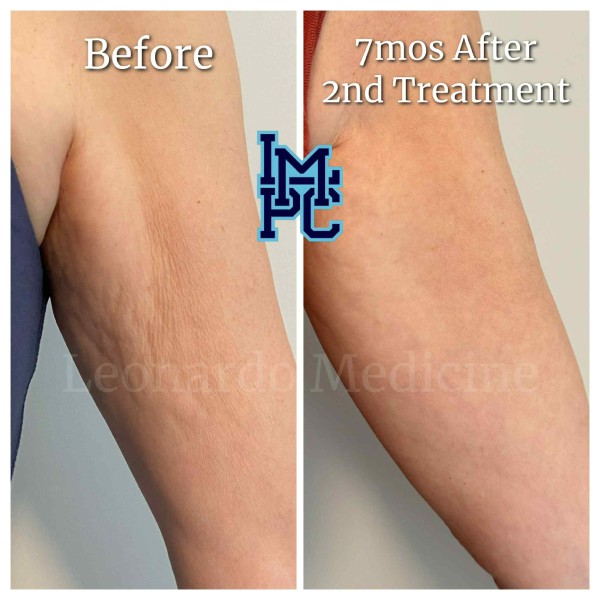 Dilute Radiesse treatment 20