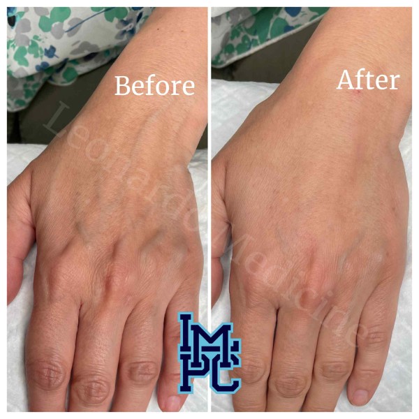 Dilute Radiesse treatment 22