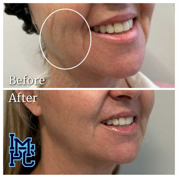 Dilute Radiesse treatment 23
