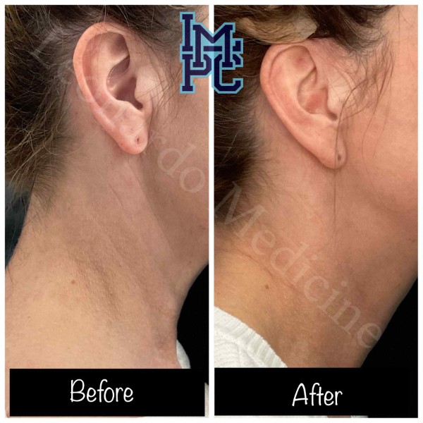 Dilute Radiesse treatment 24
