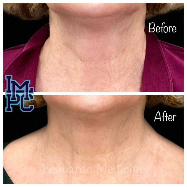 Dilute Radiesse treatment 25
