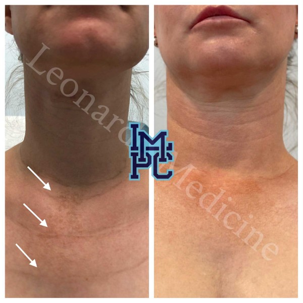 Dilute Radiesse treatment 26