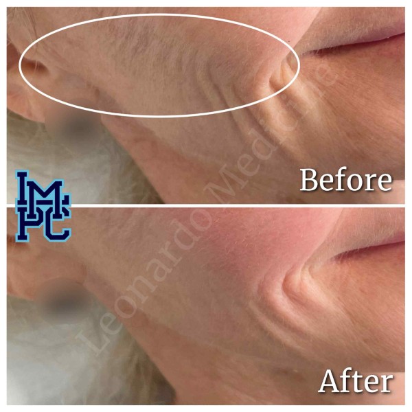 Dilute Radiesse treatment 27
