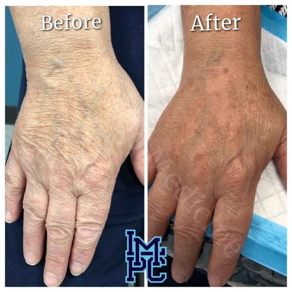 Dilute Radiesse treatment 28
