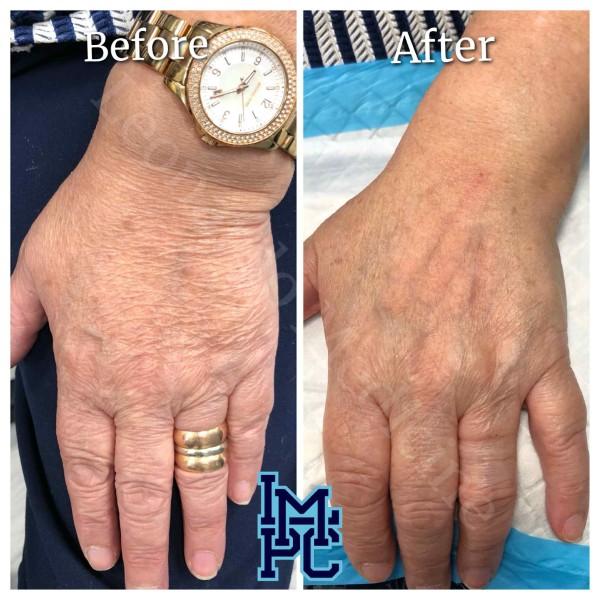 Dilute Radiesse treatment 29