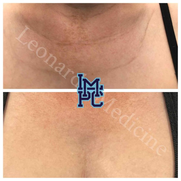 Dilute Radiesse treatment 3