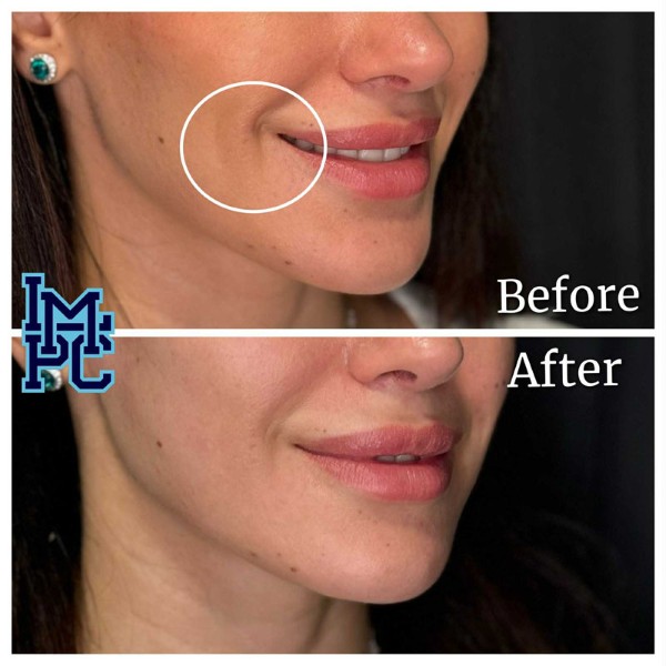 Dilute Radiesse treatment 30