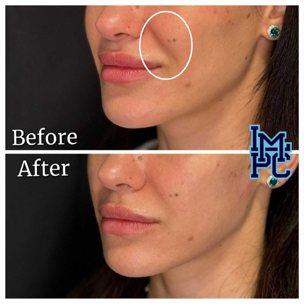 Dilute Radiesse treatment 31