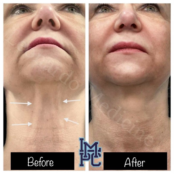Dilute Radiesse treatment 5