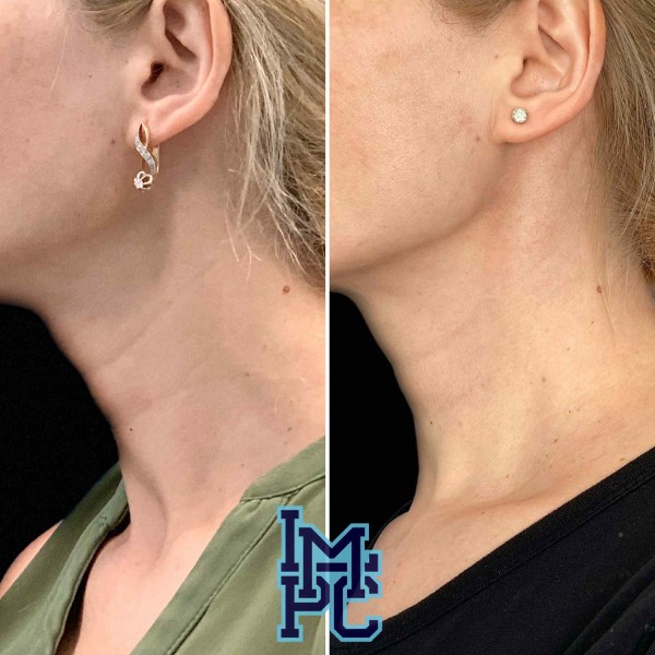 Dilute Radiesse treatment 6