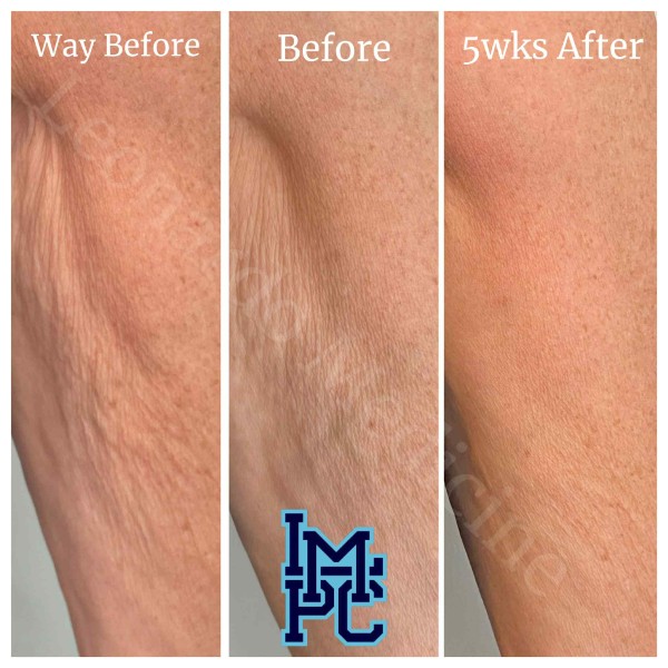 Dilute Radiesse treatment 7