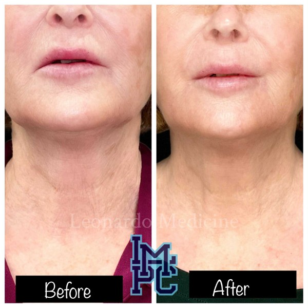Dilute Radiesse treatment 8