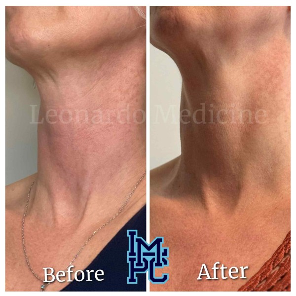 Dilute Radiesse treatment 9