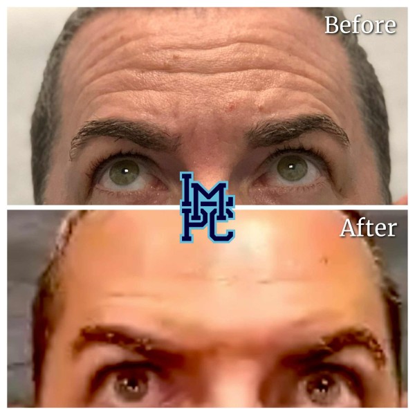 Upper Face Tox treatment 1