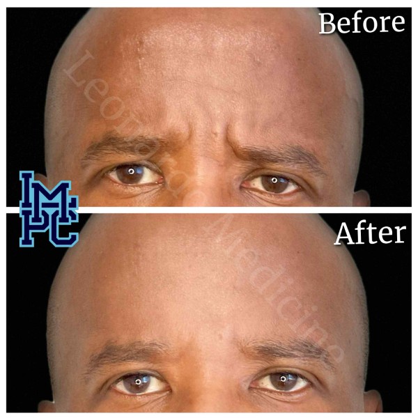 Upper Face Tox treatment 2