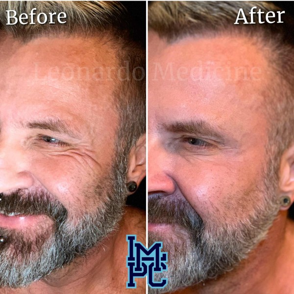 Upper Face Tox treatment 3