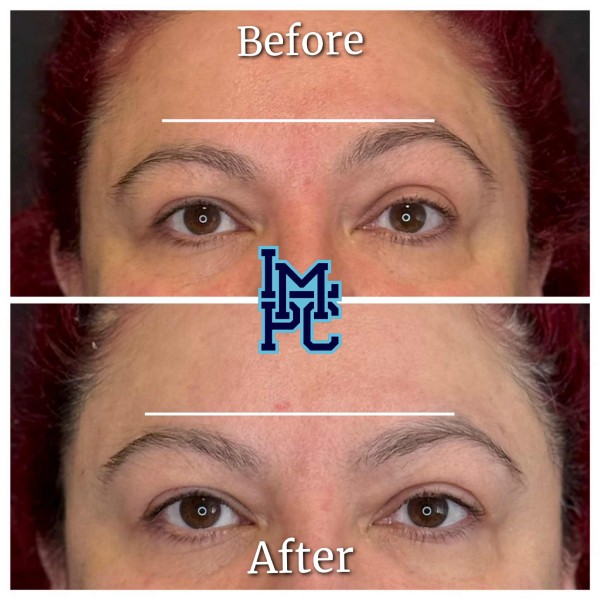 Upper Face Tox treatment 4