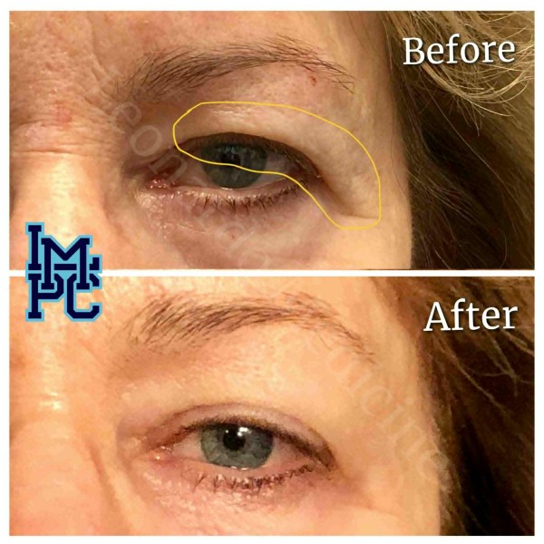 Upper Face Tox treatment 5